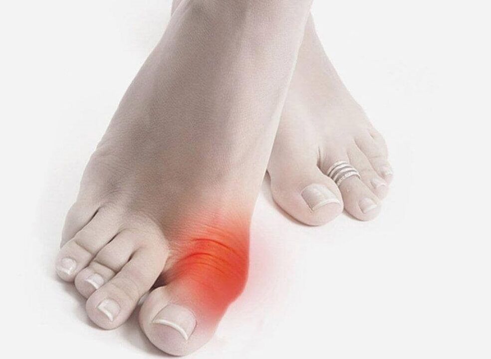 síntomas de la gota en el pie